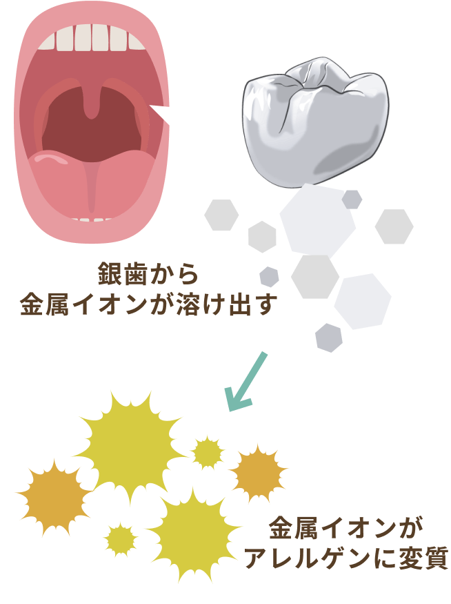 歯科金属が原因で起こる歯科金属アレルギー