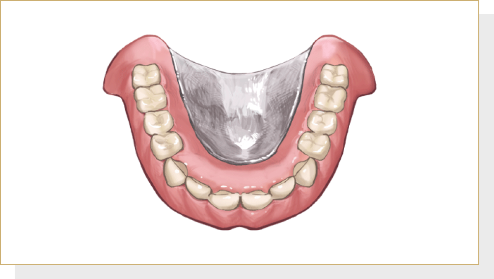 金属床義歯